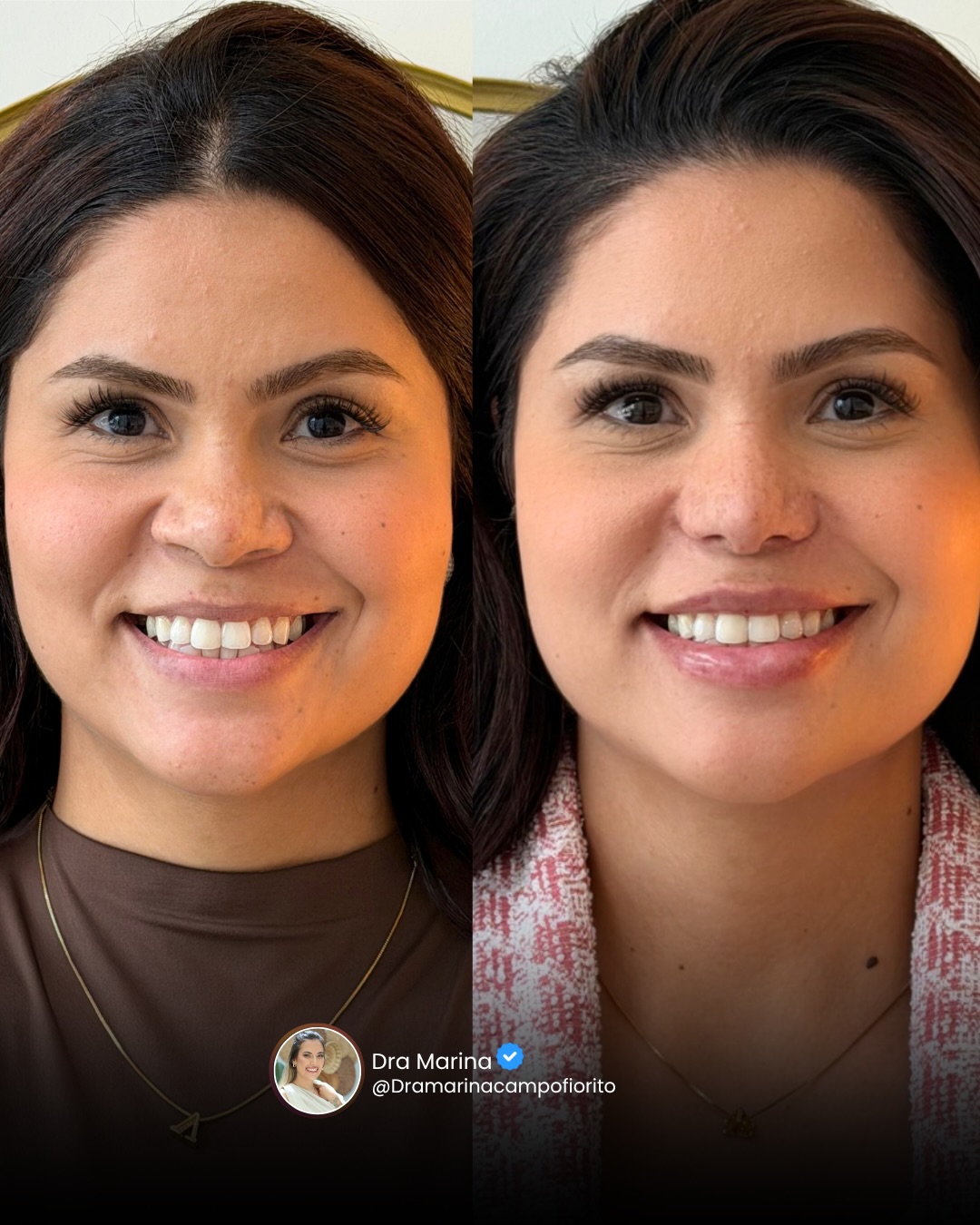 Antes e depois de rinoplastia frontal · Dra. Marina Campofiorito