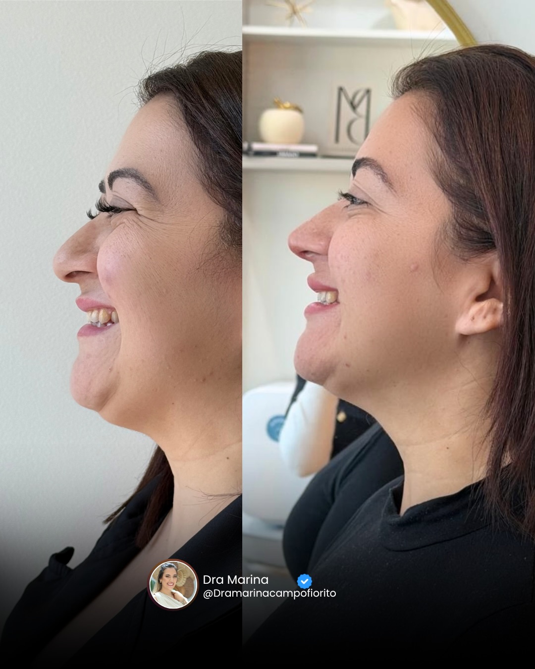 Antes e depois de rinoplastia de perfil · Dra. Marina Campofiorito