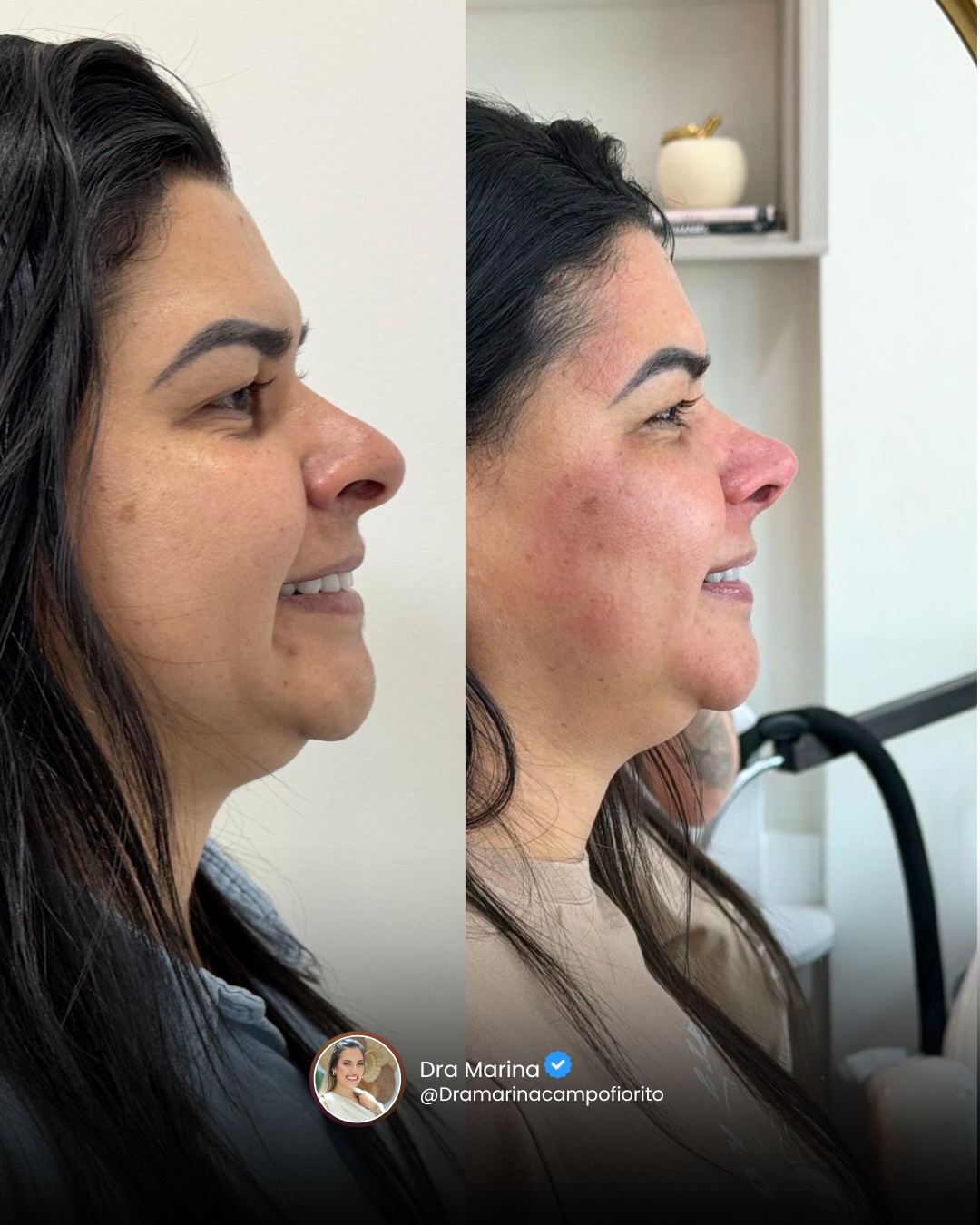 Antes e depois de nariz de perfil · Dra. Marina Campofiorito